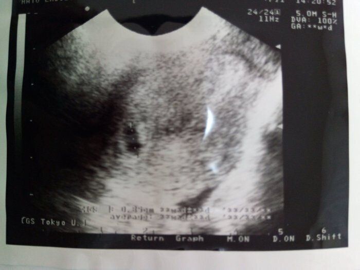 妊娠6週目のエコー写真