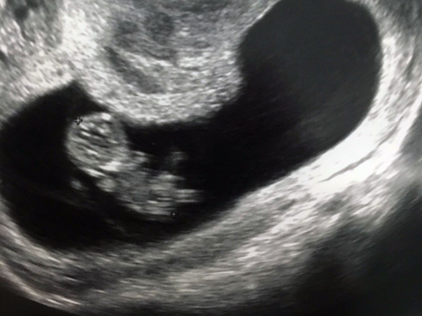 おなかの中で何しているの エコー写真で振り返る妊娠期 たまひよ おなかの中で何しているの エコー写真で振り返る妊娠期 たまひよ