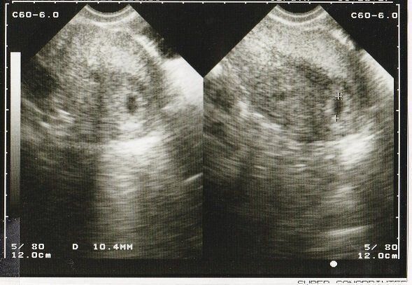 妊娠5週目のエコー写真