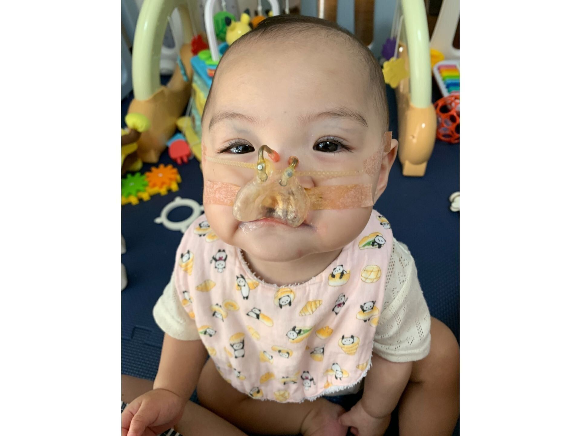 このお口、見れなくなるの少し寂しい」。口唇口蓋裂の子を育てる