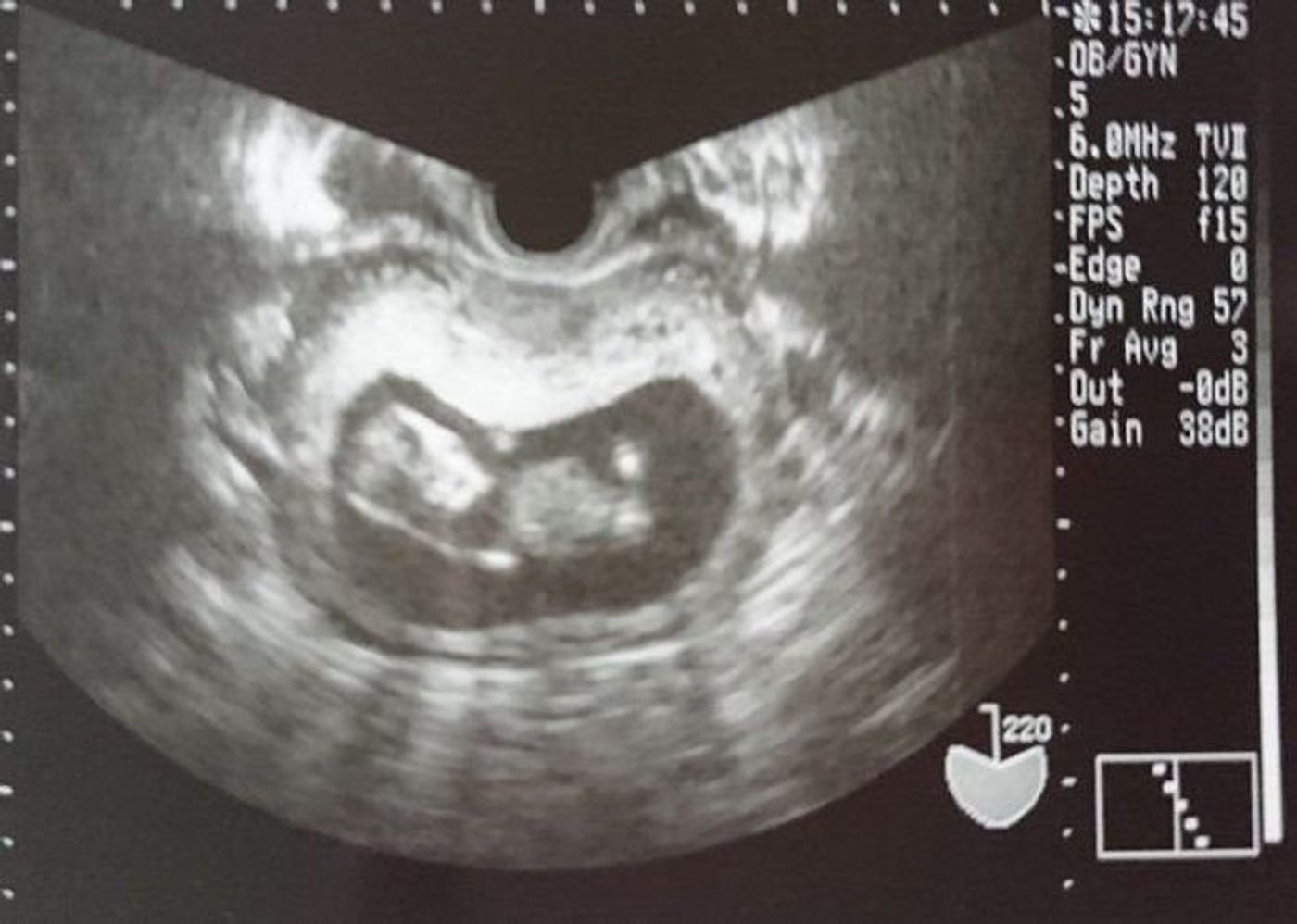 妊娠11週 赤ちゃんのエコー写真 超音波写真まとめ たまひよ 妊娠11週 赤ちゃんのエコー写真 超音波写真まとめ たまひよ