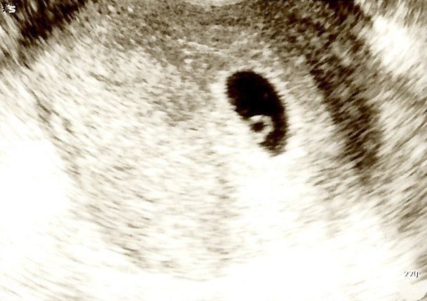 （超音波写真提供／新村朋美先生）