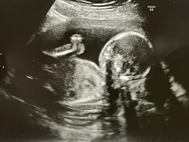 出産体験談　早産　無痛分娩　新生児仮死