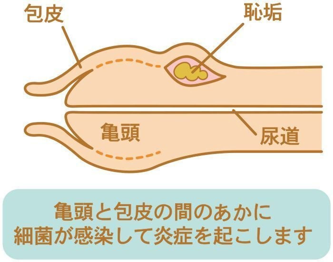 男の子の赤ちゃんの泌尿器 性器の病気 亀頭包皮炎の症状とケア 医師監修 たまひよ 男の子の赤ちゃんの泌尿器 性器の病気 亀頭包皮炎の症状とケア 医師監修 たまひよ
