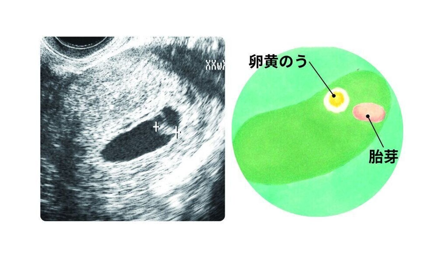 妊娠 5 週 目 エコー