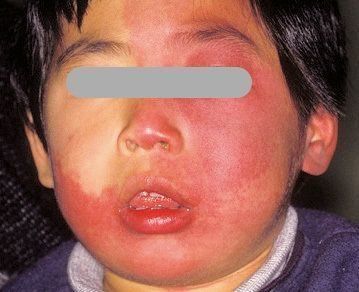 赤ちゃんの皮膚の病気 あざの症状とケア【医師監修】｜たまひよ
