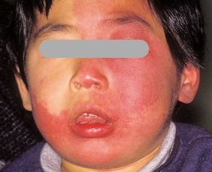 赤ちゃんの皮膚の病気 あざの症状とケア 医師監修 たまひよ 赤ちゃんの皮膚の病気 あざの症状とケア 医師監修 たまひよ