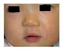 口唇口蓋裂とは？発症頻度・原因・治療法・ホームケアまで【医師