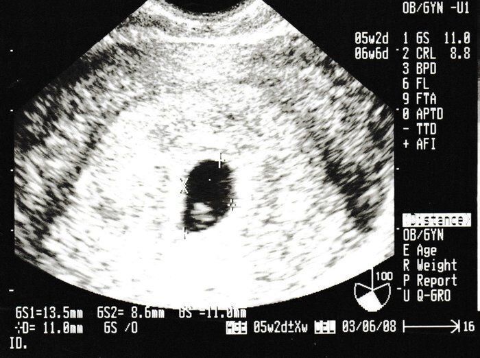 妊娠6週目のエコー写真