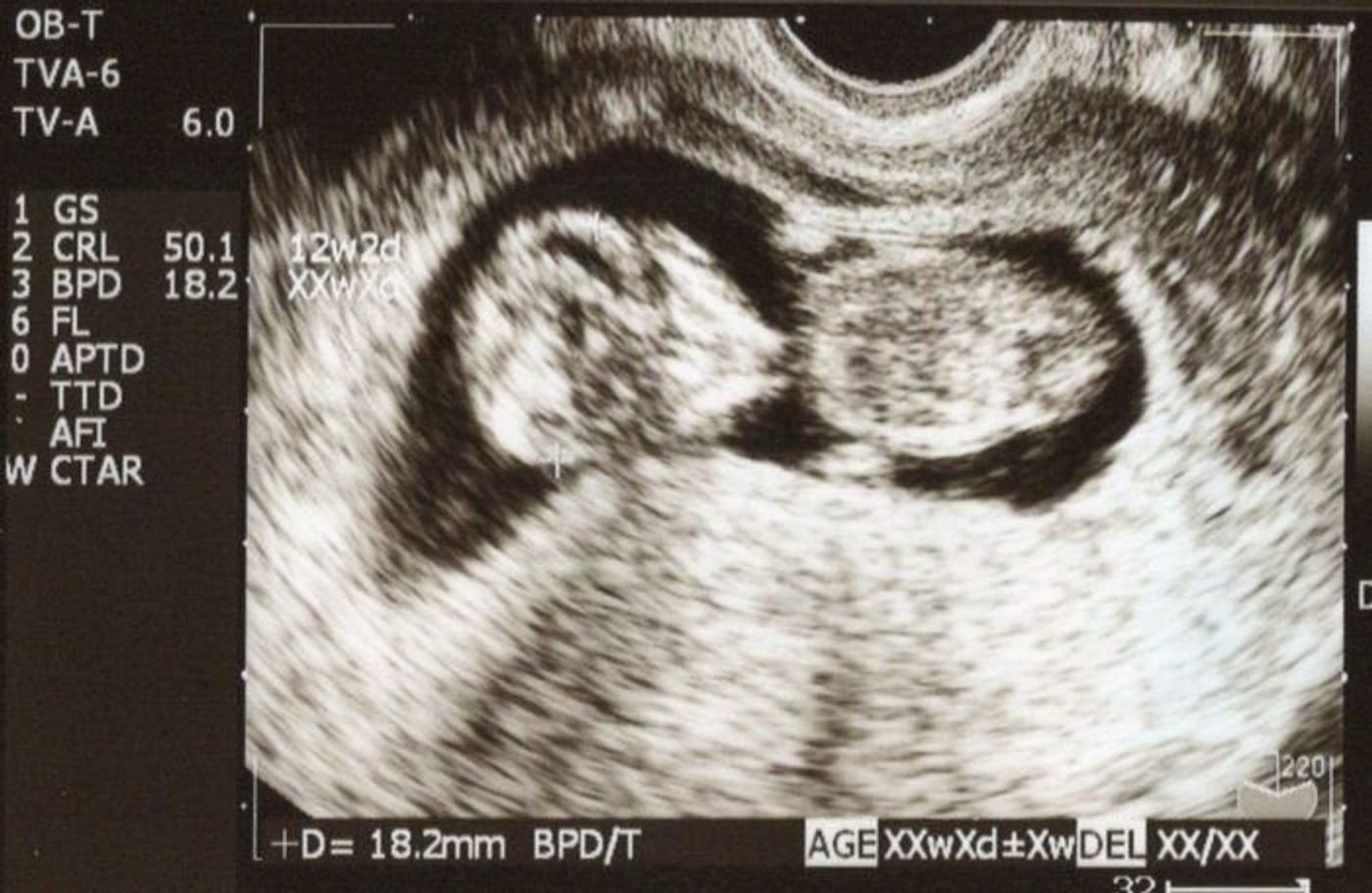 妊娠10週 赤ちゃんのエコー写真 超音波写真まとめ たまひよ 妊娠10週 赤ちゃんのエコー写真 超音波写真まとめ たまひよ