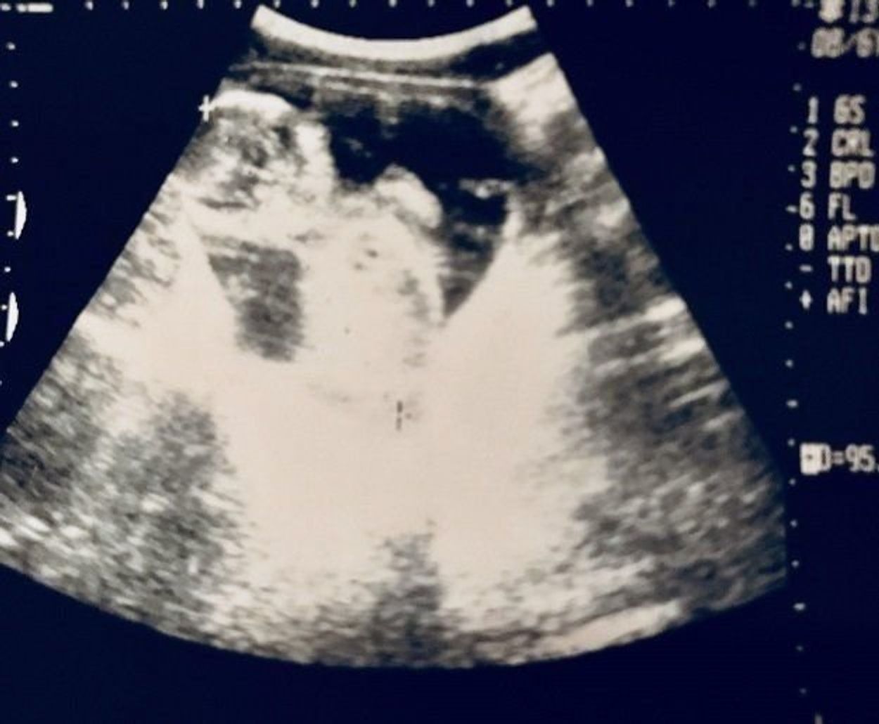 妊娠14週 赤ちゃんのエコー写真 超音波写真まとめ たまひよ 妊娠14週 赤ちゃんのエコー写真 超音波写真まとめ たまひよ