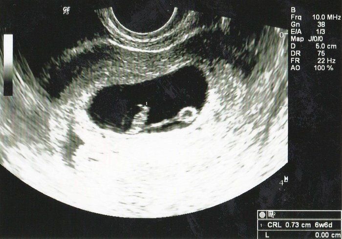 妊娠6週目のエコー写真