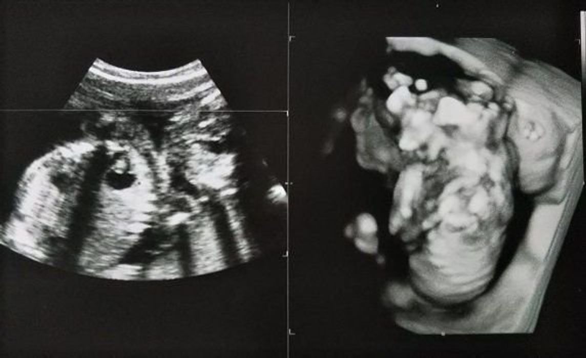 妊娠19週 赤ちゃんのエコー写真 超音波写真まとめ たまひよ 妊娠19週 赤ちゃんのエコー写真 超音波写真まとめ たまひよ