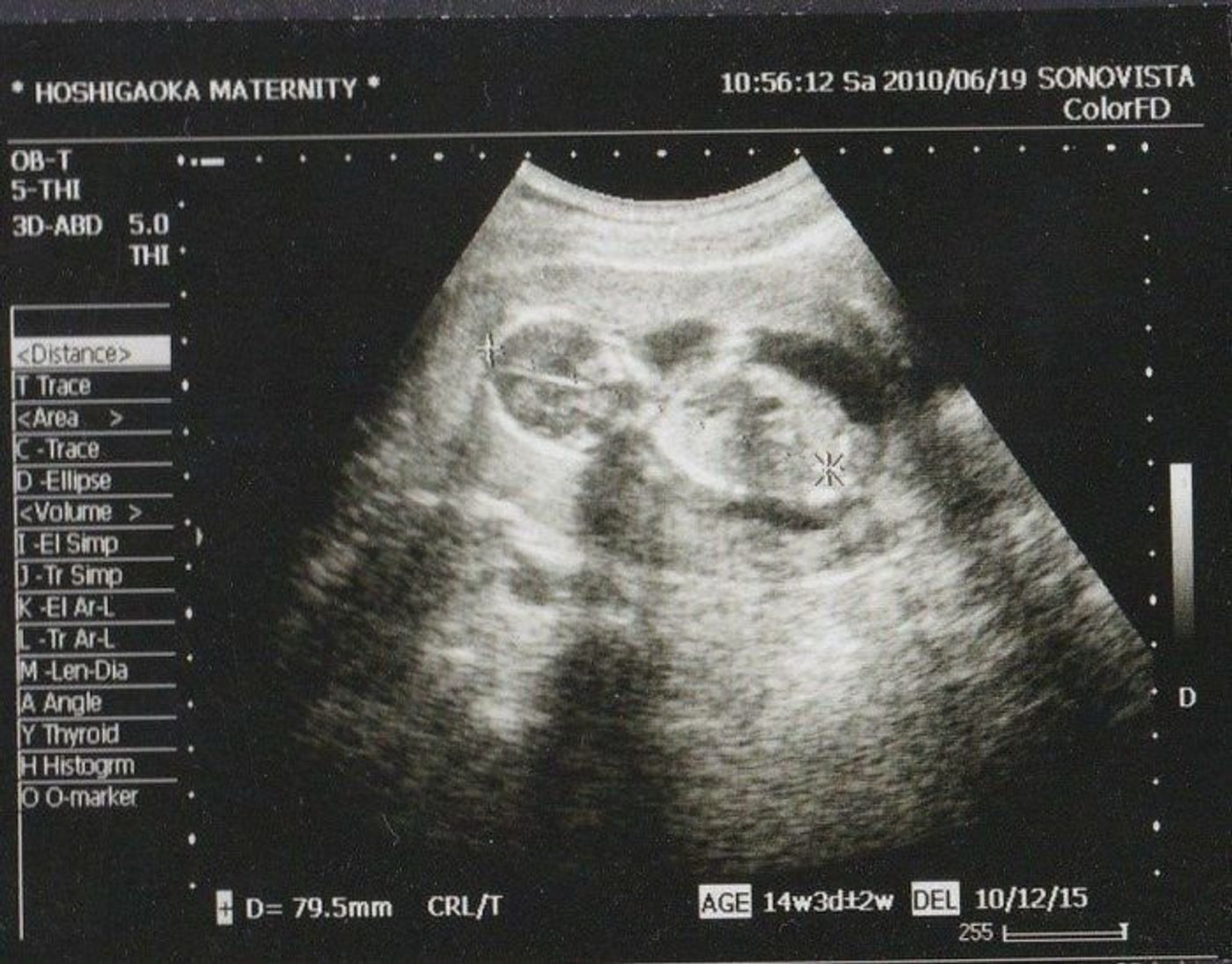 妊娠14週 赤ちゃんのエコー写真 超音波写真まとめ たまひよ 妊娠14週 赤ちゃんのエコー写真 超音波写真まとめ たまひよ