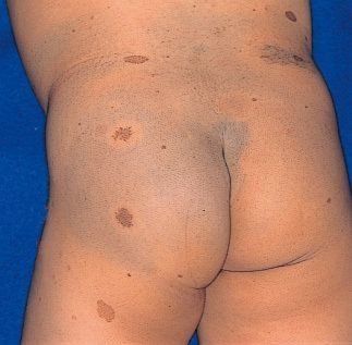 流星 マスク 製油所 レック リング ハウゼン 病 赤ちゃん 脱臼する 金属 モーション