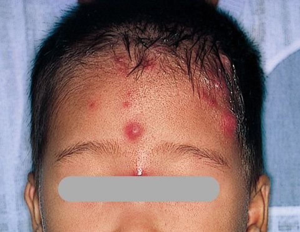 赤ちゃんの皮膚の病気 あせもの症状とケア 医師監修 たまひよ 赤ちゃんの皮膚の病気 あせもの症状とケア 医師監修 たまひよ