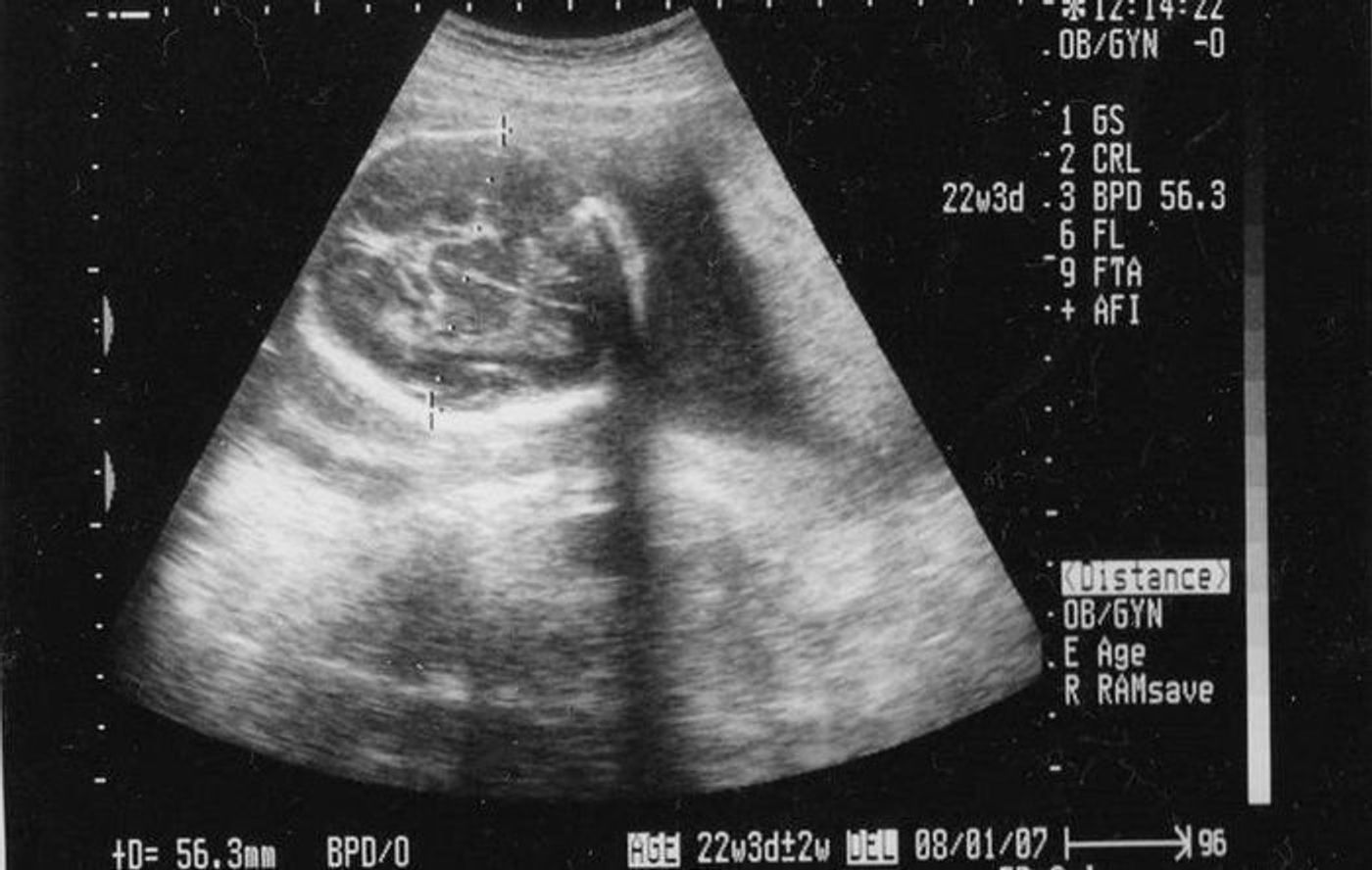 妊娠22週 赤ちゃんのエコー写真 超音波写真まとめ たまひよ 妊娠22週 赤ちゃんのエコー写真 超音波写真まとめ たまひよ