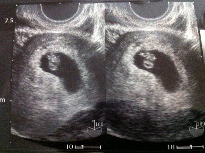 妊娠6週目のエコー写真