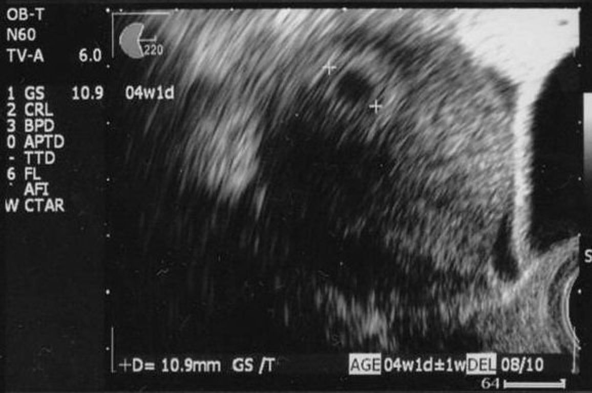 妊娠4週 赤ちゃんのエコー写真 超音波写真まとめ たまひよ 妊娠4週 赤ちゃんのエコー写真 超音波写真まとめ たまひよ