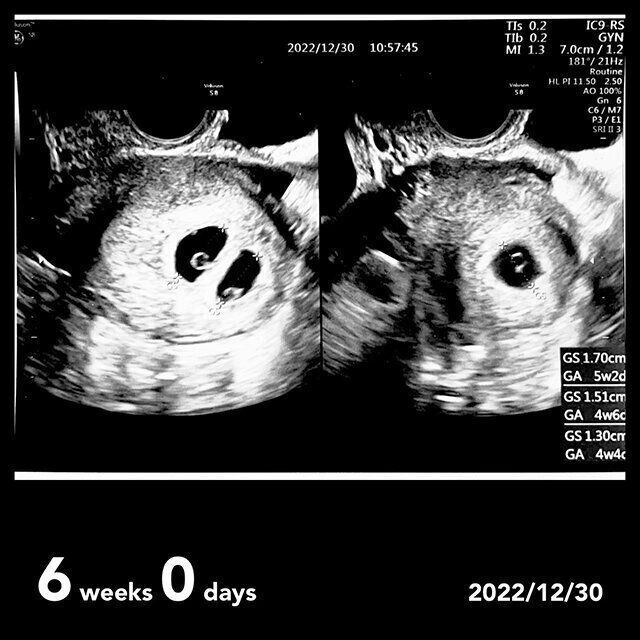 momoさん 3つ子育児体験談　エコー写真