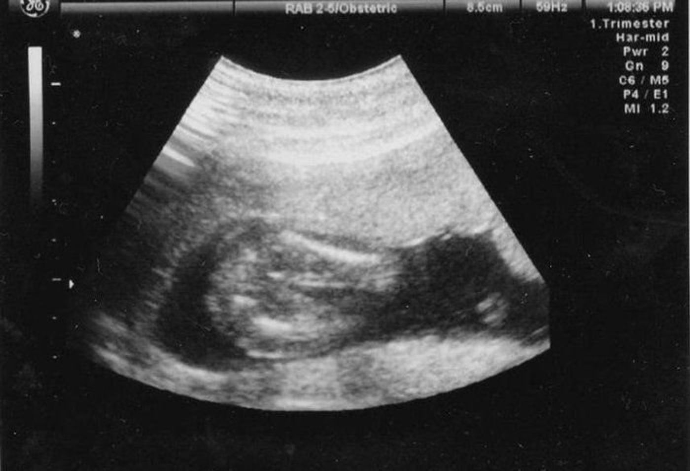 妊娠18週 赤ちゃんのエコー写真 超音波写真まとめ たまひよ 妊娠18週 赤ちゃんのエコー写真 超音波写真まとめ たまひよ