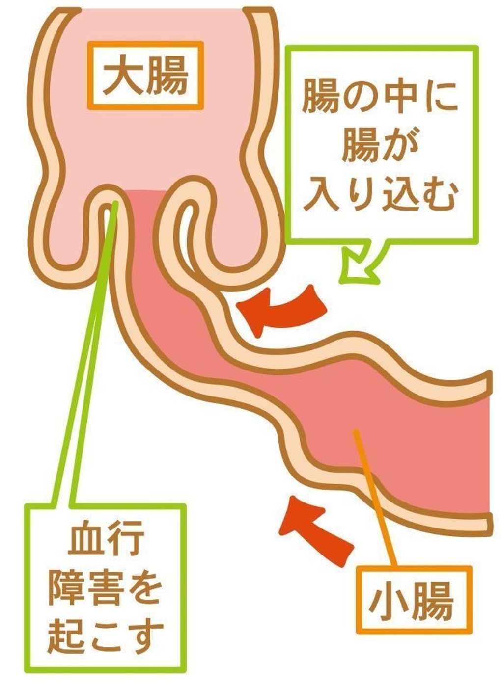 赤ちゃんのおなかの病気 腸重積症の症状とケア 医師監修 たまひよ 赤ちゃんのおなかの病気 腸重積症の症状とケア 医師監修 たまひよ
