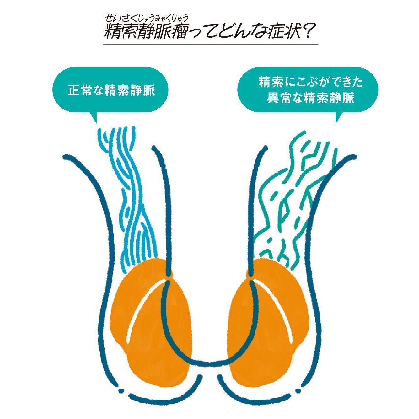 精索静脈瘤（せいさくじょうみゃくりゅう）ってどんな症状？