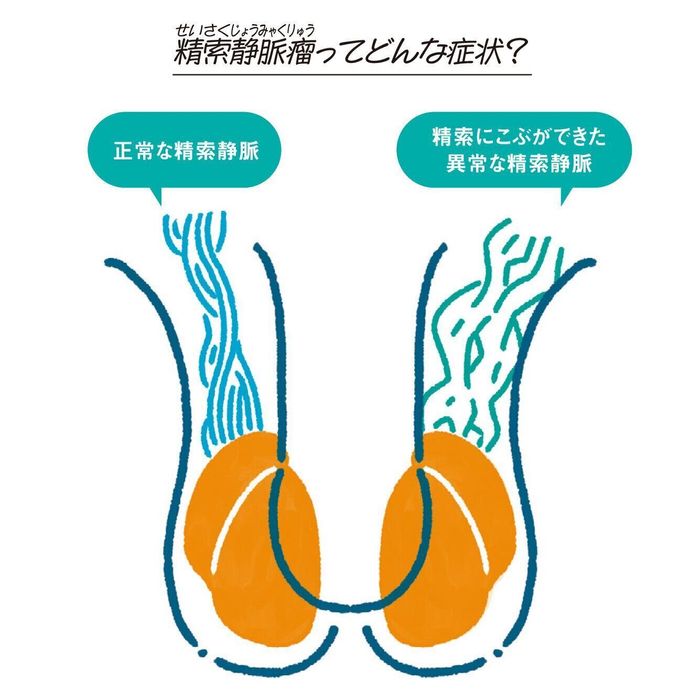 精索静脈瘤(せいさくじょうみゃくりゅう)ってどんな症状?