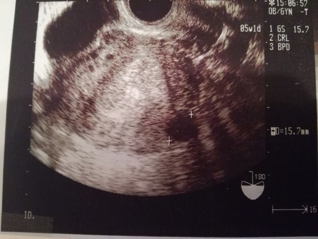 妊娠5週目のエコー写真