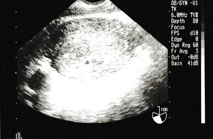 妊娠4週目のエコー写真