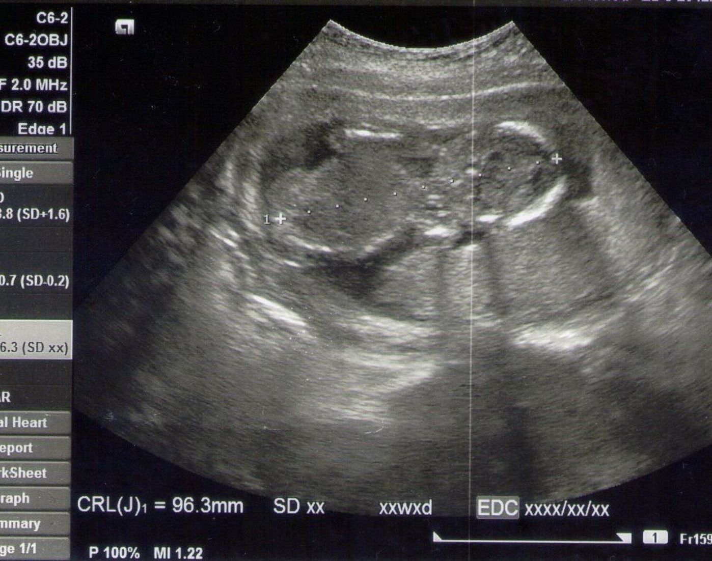 エコー画像で赤ちゃんを感じ 不安も乗り越えた 初めてのマタニティライフ たまひよ エコー画像で赤ちゃんを感じ 不安も乗り越えた 初めてのマタニティライフ たまひよ