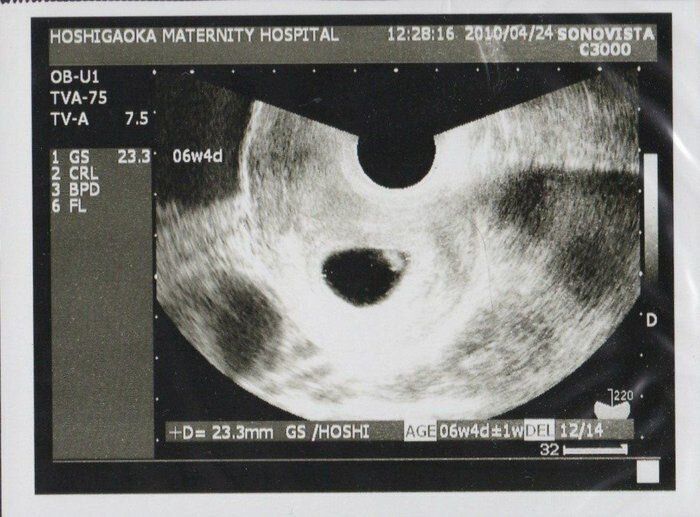妊娠6週目のエコー写真