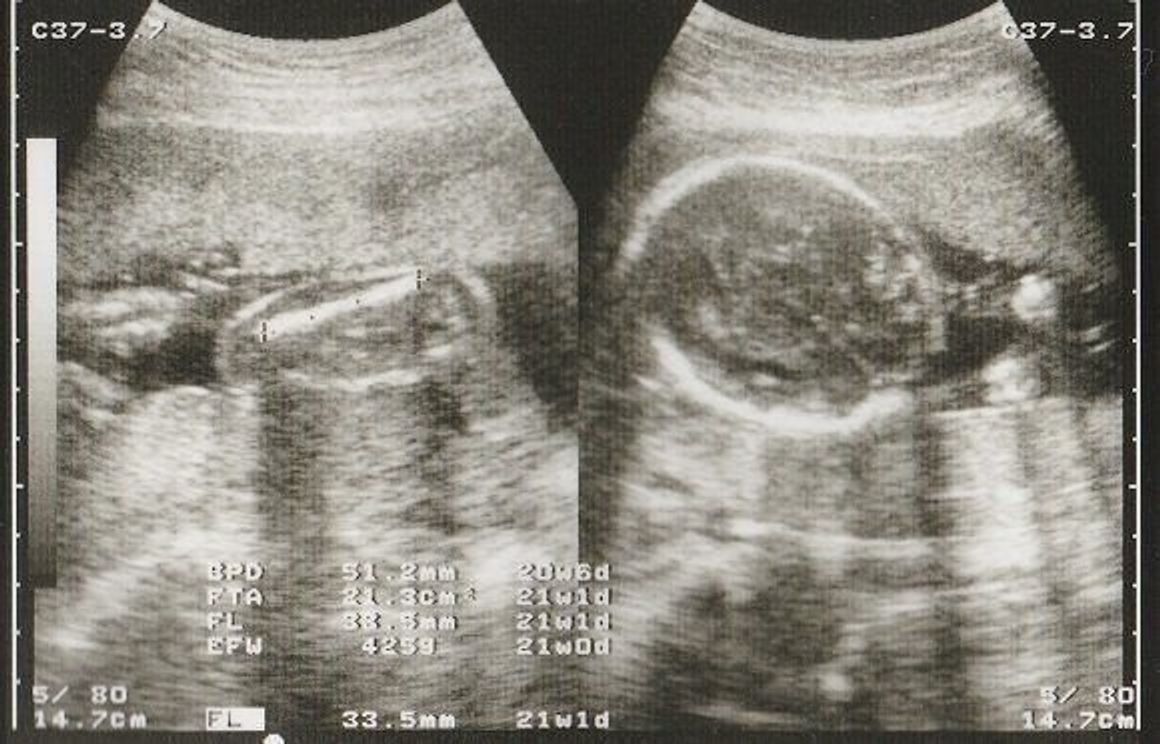 妊娠21週 赤ちゃんのエコー写真 超音波写真まとめ たまひよ 妊娠21週 赤ちゃんのエコー写真 超音波写真まとめ たまひよ