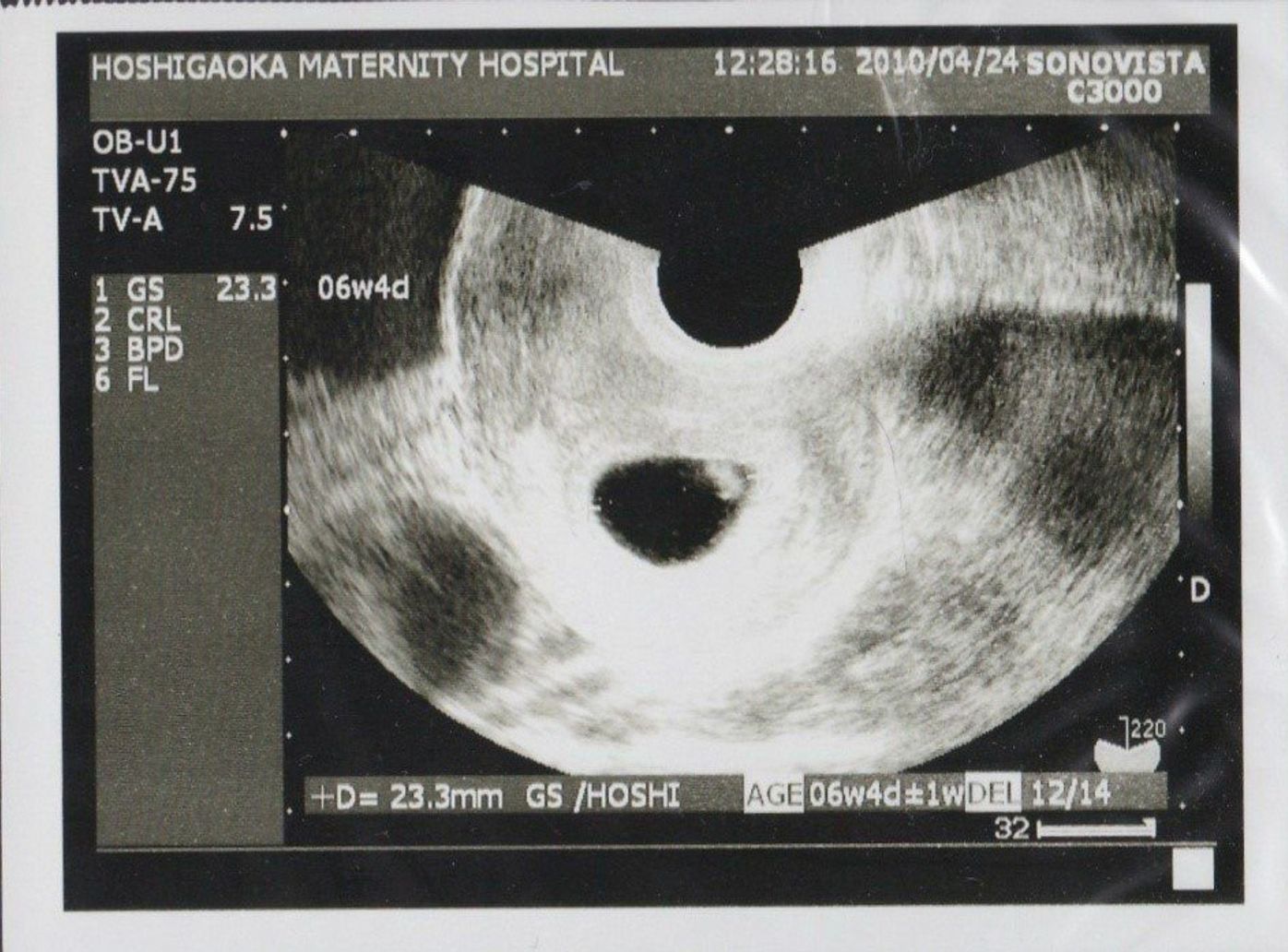 推定体重は3773g 骨盤に入らず緊急帝王切開になった長女の成長をエコー写真で振り返る たまひよ 推定体重は3773g 骨盤に入らず緊急帝王切開になった長女の成長をエコー写真で振り返る たまひよ