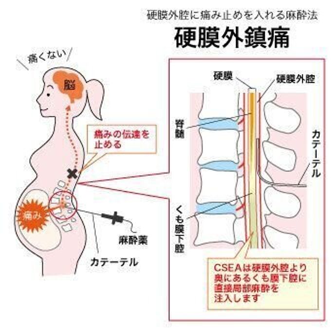 医師監修 無痛分娩で使う麻酔薬とは 副作用や持続時間を詳しく解説 たまひよ 医師監修 無痛分娩で使う麻酔薬とは 副作用や持続時間を詳しく解説 たまひよ