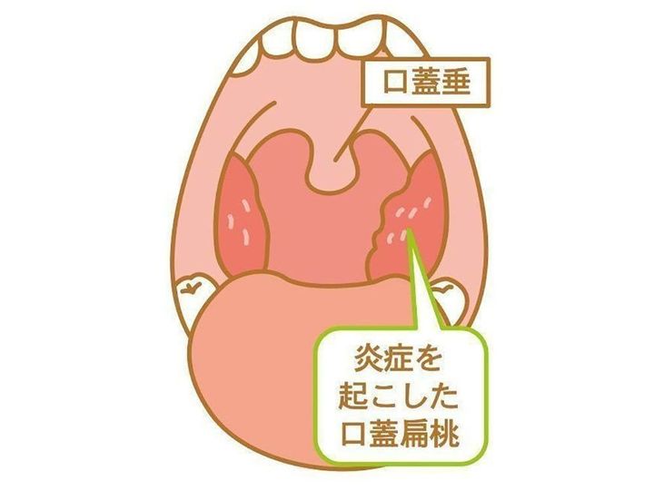 赤ちゃん のど 気管支 肺の病気 扁桃炎の症状とケア 医師監修 たまひよ 赤ちゃん のど 気管支 肺の病気 扁桃炎の症状とケア 医師監修 たまひよ