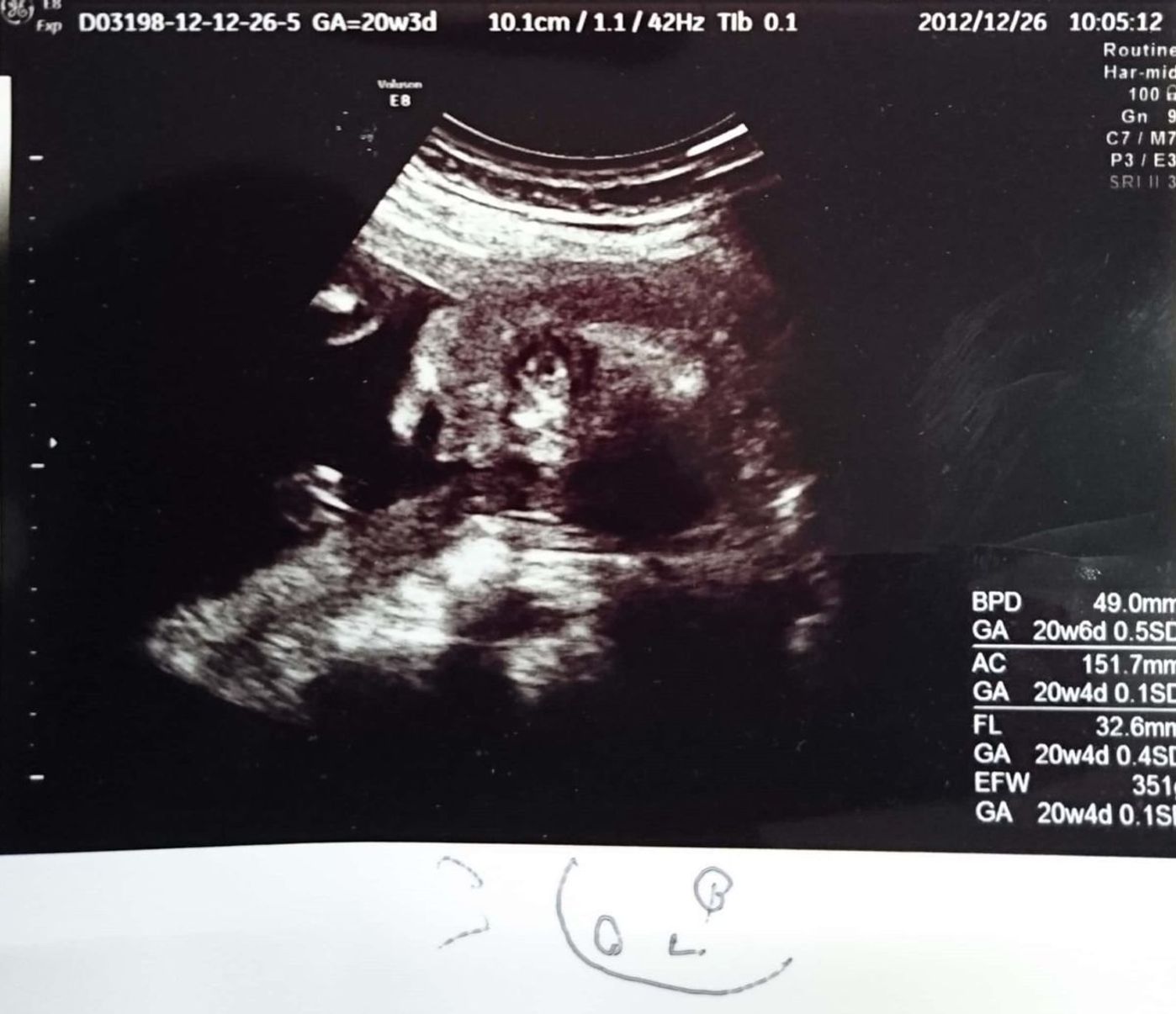 おなかの中にいる時からそっくり 今見ても笑っちゃう 第1子エコー写真 たまひよ おなかの中にいる時からそっくり 今見ても笑っちゃう 第1子エコー写真 たまひよ