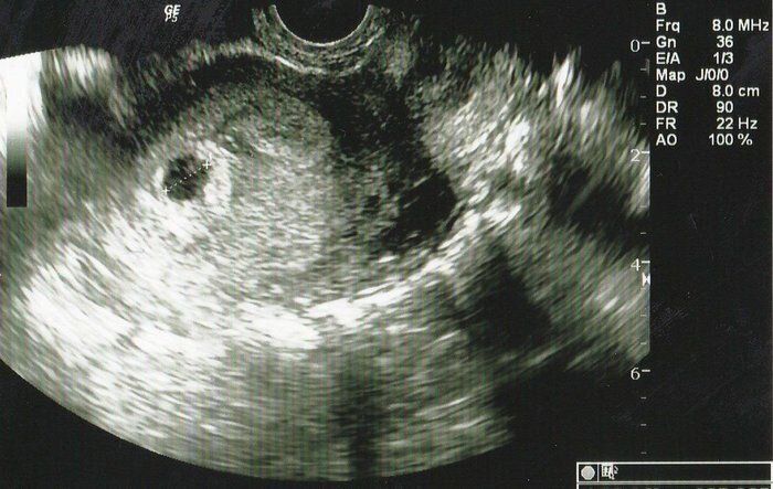 妊娠4週目のエコー写真