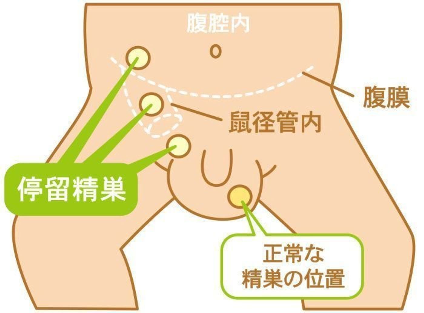 男の子赤ちゃんの泌尿器 性器の病気 停留精巣 停留睾丸の症状とケア 医師監修 たまひよ 男の子赤ちゃんの泌尿器 性器の病気 停留精巣 停留睾丸の症状とケア 医師監修 たまひよ