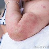 動画 生まれてすぐからできる アトピー アレルギーにさせない生活 たまひよ 動画 生まれてすぐからできる アトピー アレルギーにさせない生活 たまひよ