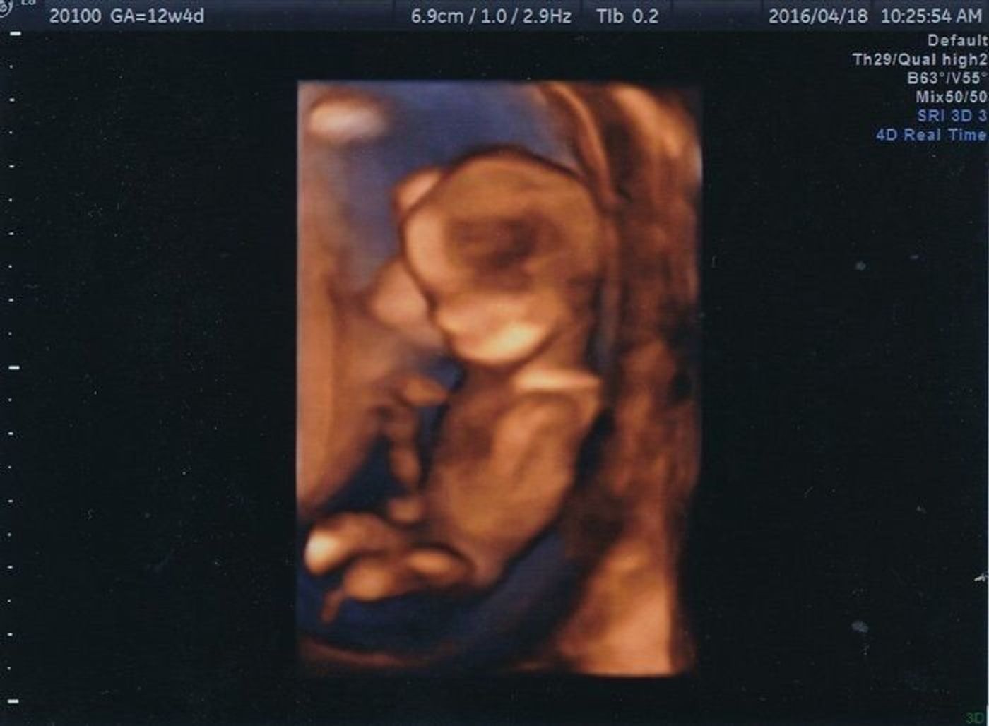 妊娠12週 赤ちゃんのエコー写真 超音波写真まとめ たまひよ 妊娠12週 赤ちゃんのエコー写真 超音波写真まとめ たまひよ