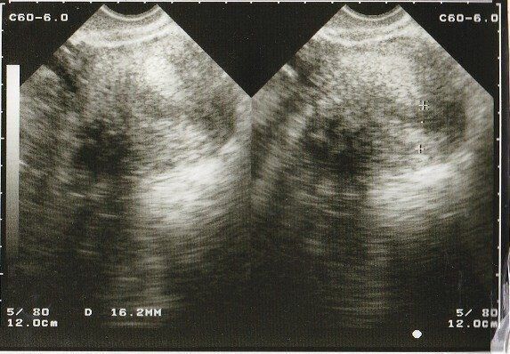 妊娠4週目のエコー写真