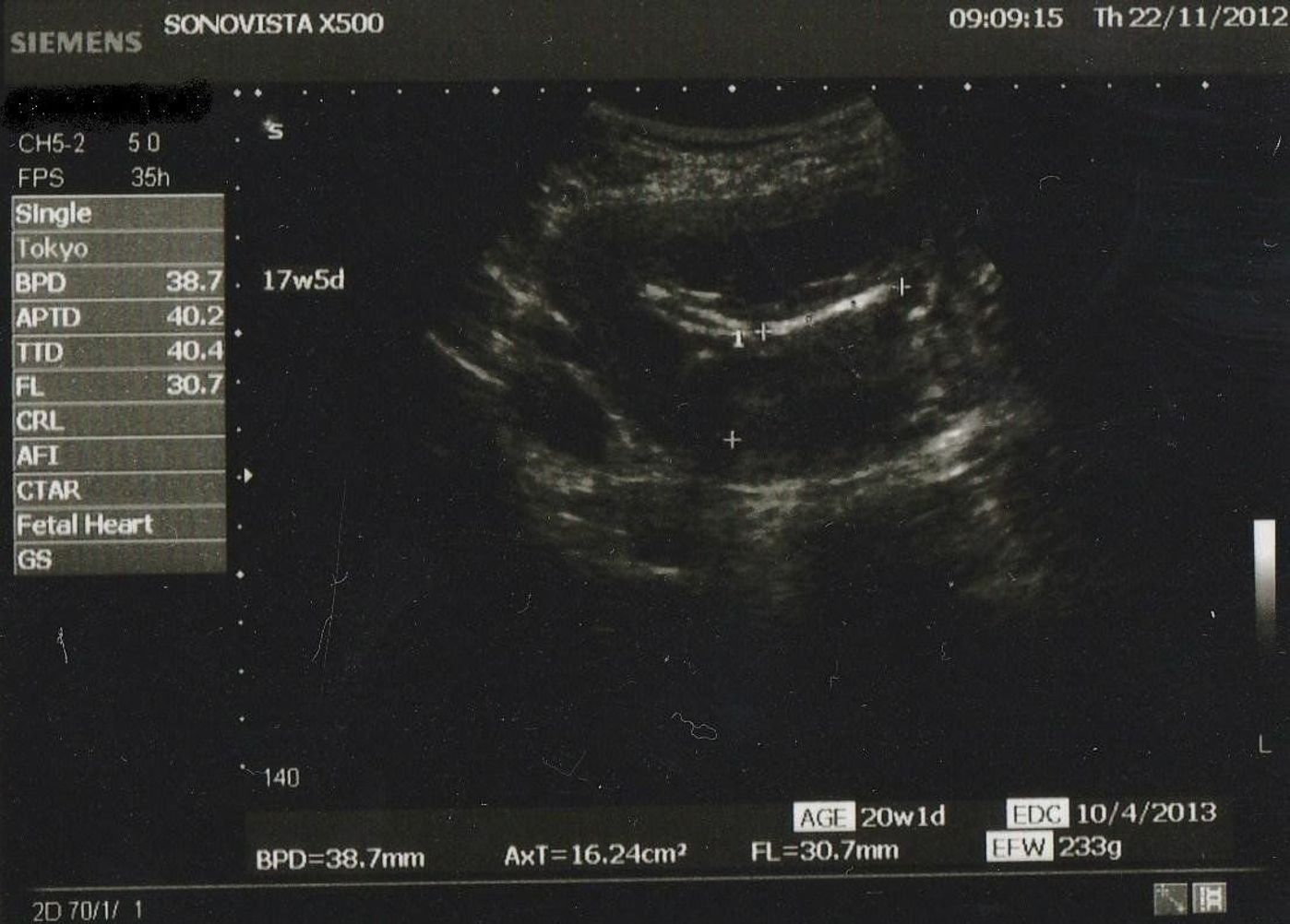 生まれる前からエコー写真を通して 娘を お姉ちゃん にしてくれた次女の存在 たまひよ 生まれる前からエコー写真を通して 娘を お姉ちゃん にしてくれた次女の存在 たまひよ