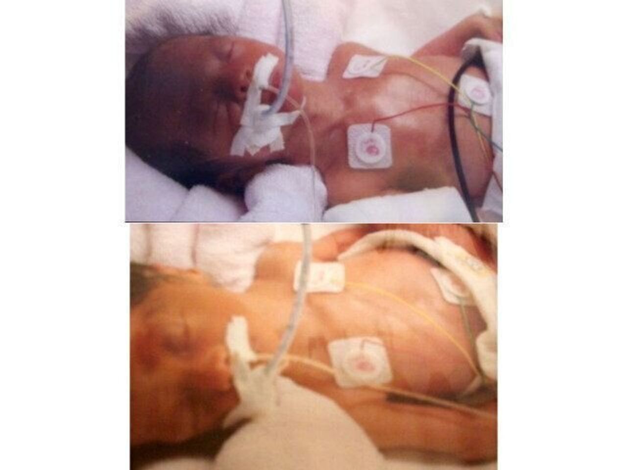 妊娠線 素人 妊娠28週で双子を出産。長女だけが脳性まひと診断され…。『早産さえしなければ』と自分を責め、涙が止まらなかった【体験談】|たまひよ