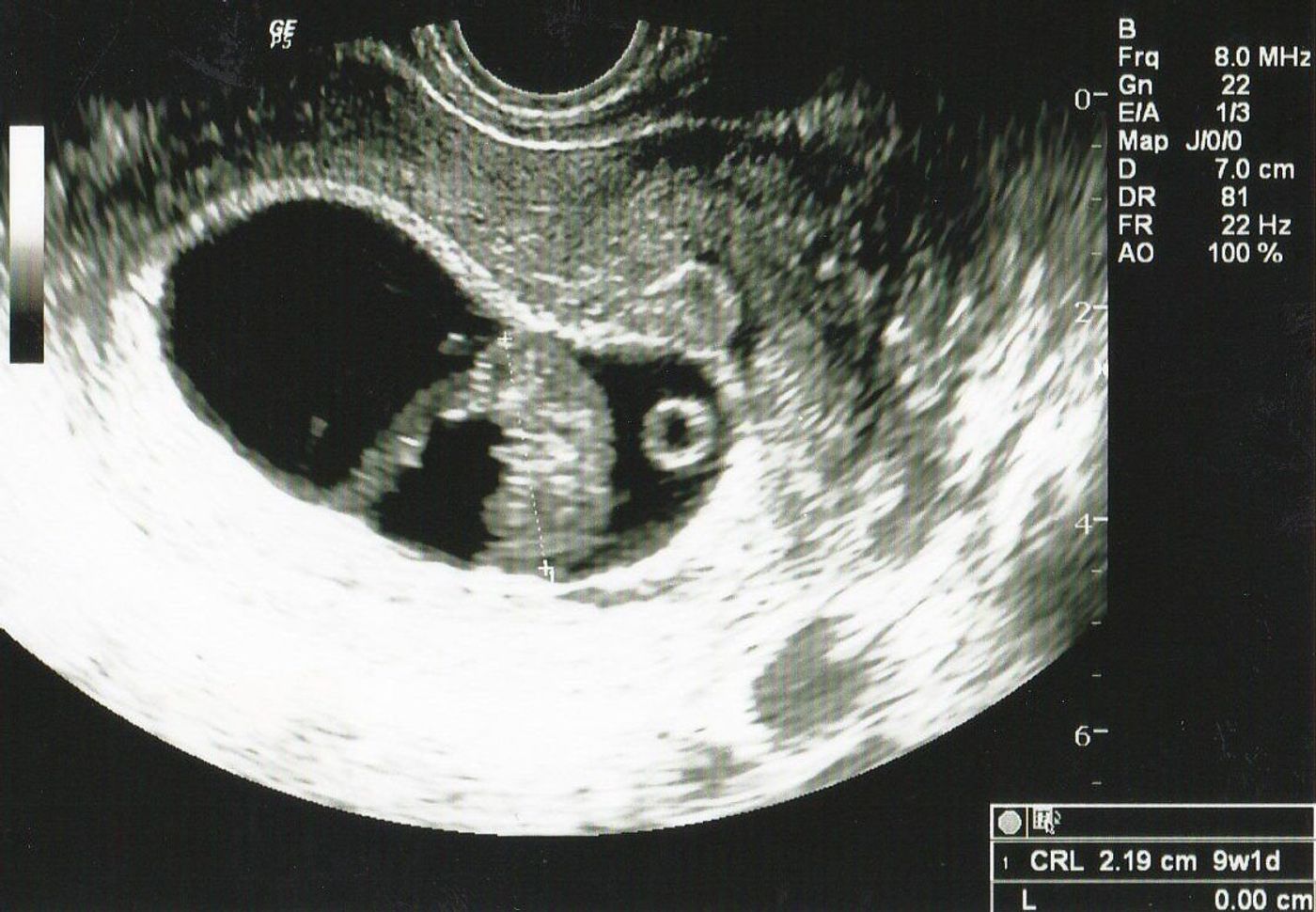 エコー画像で振り返る 私に宿った小さな命が大きく育って誕生するまでの記録 たまひよ エコー画像で振り返る 私に宿った小さな命が大きく育って誕生するまでの記録 たまひよ