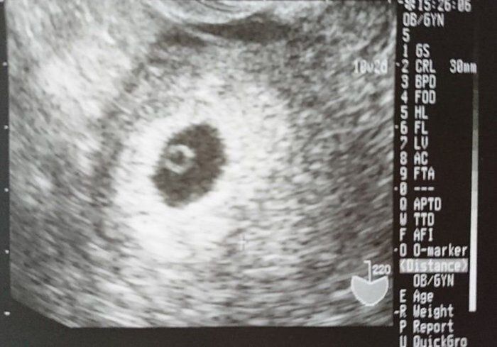 妊娠6週目のエコー写真