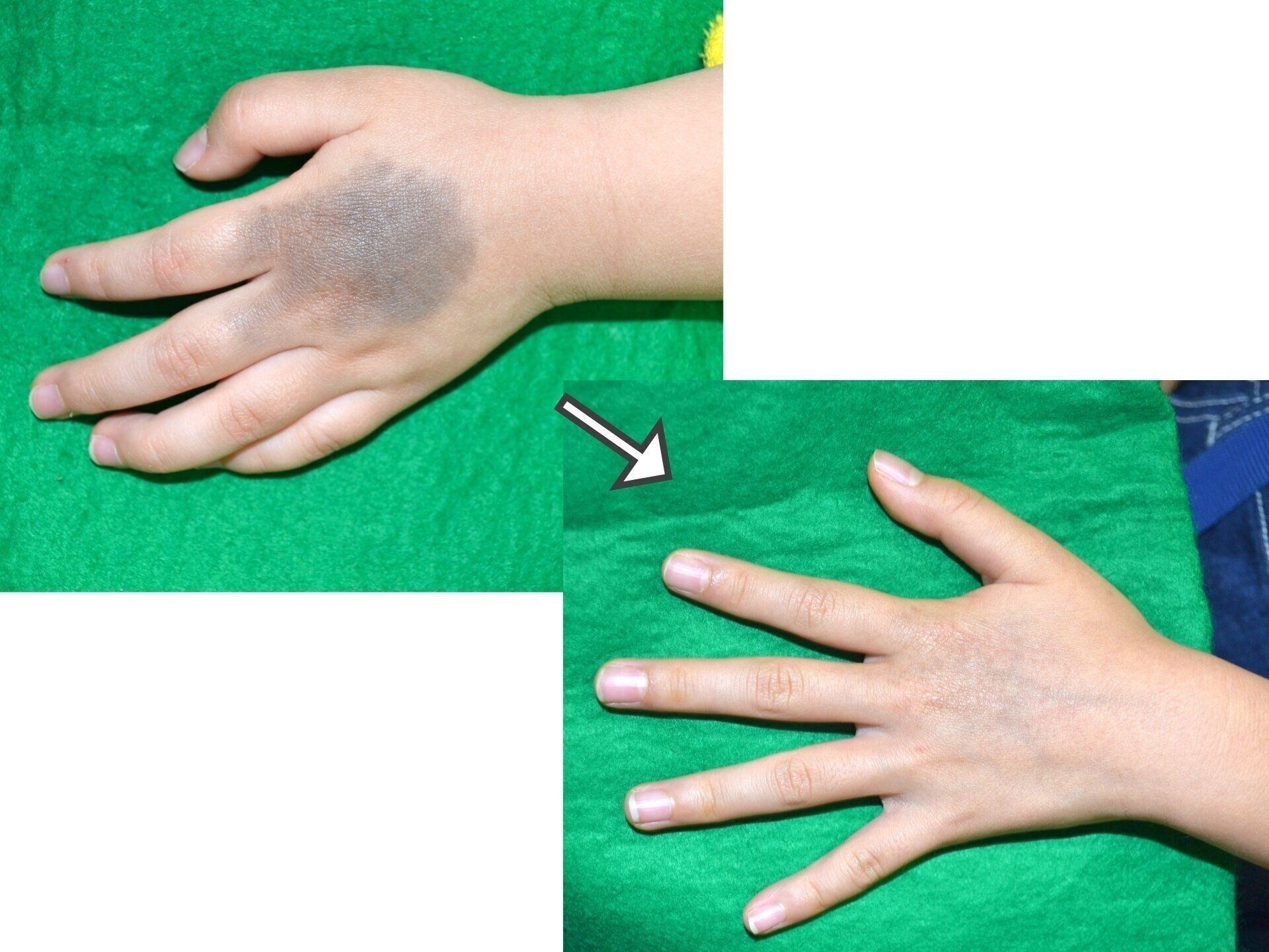 赤ちゃんのあざ 心配しなくていい 治療すべき 最新レーザー治療情報も 専門医 たまひよ