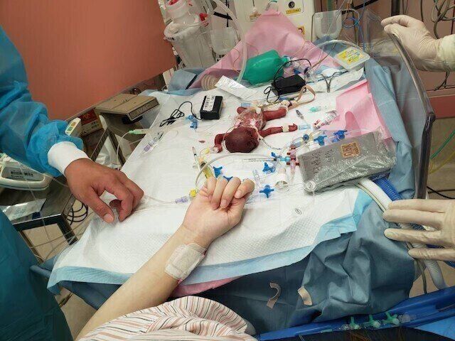命の決断を迫られ 470gの超低出生体重児で生まれた娘 手のひらに乗るほど小さな娘を見て涙が止まらなかった たまひよ