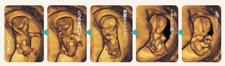 4D超音波妊娠11週連続ショットの画像