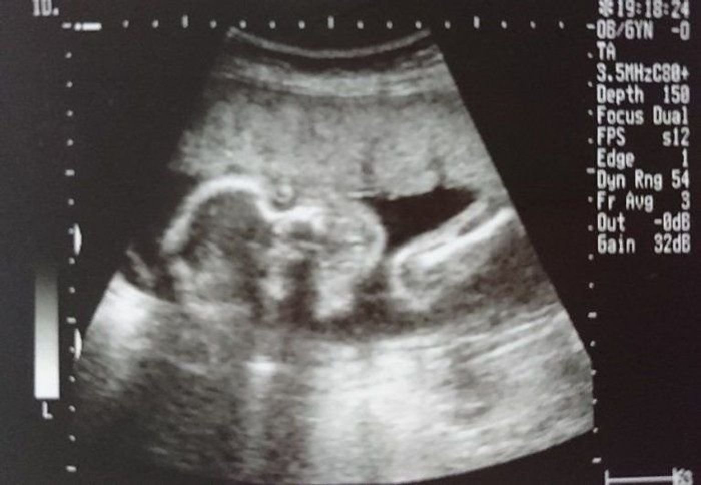 妊娠22週 赤ちゃんのエコー写真 超音波写真まとめ たまひよ 妊娠22週 赤ちゃんのエコー写真 超音波写真まとめ たまひよ